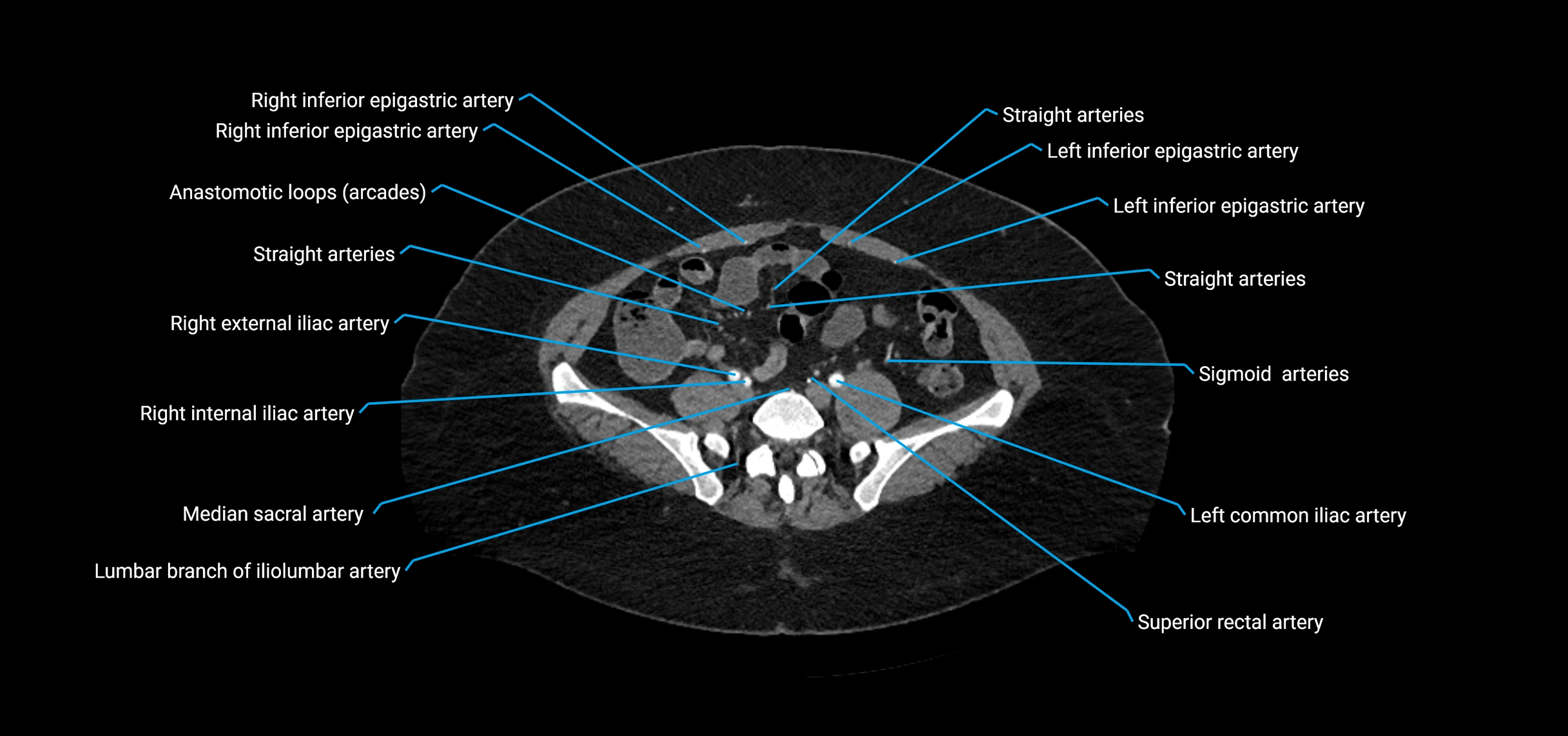CTA abdomen axial cross sectional anatomy labelled image_170 (2).webp